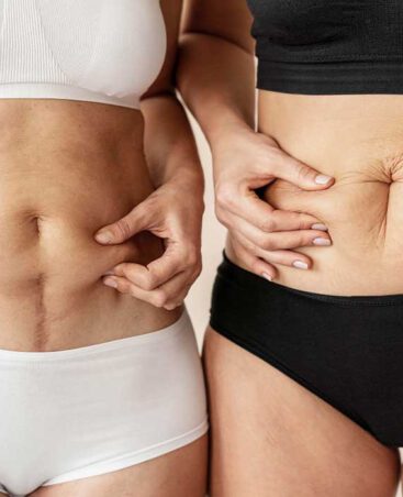 dehnungsstreifen-leistung