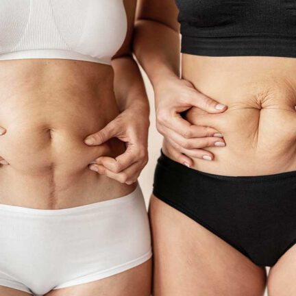 dehnungsstreifen-leistung